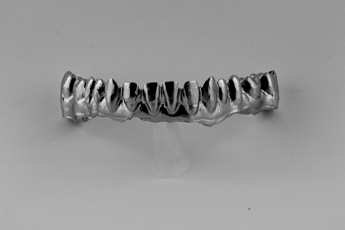 Prodontec-armature-metal-sur-implant-vue-vestibulaire.