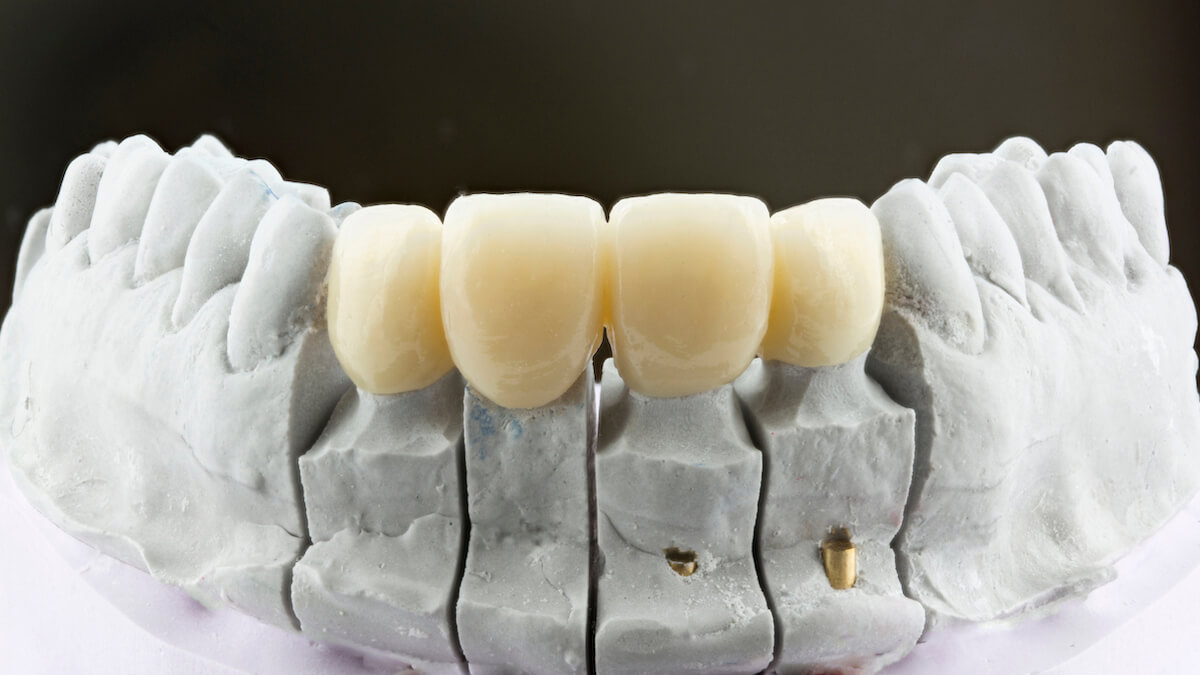 Prodontec-bridge-zircone-stratefiee-face-vestibulaire