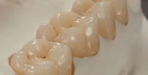 zirconia-04